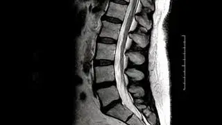 MRI For Low Back Pain? When? | Chiropractor Mechanicsville & Richmond VA