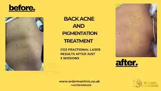 How to Get Rid of Back Acne Scars FAST | Laser Treatment Results!