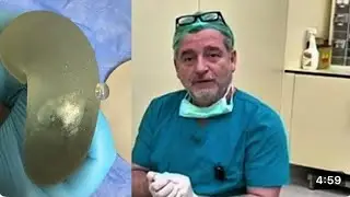 Breast Implant Replacement After 22 Years: Educational Case Review
