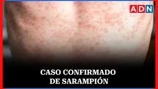 Se activan protocolos de vigilancia y llamado a vacunarse tras detectarse caso de sarampión
