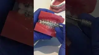 Class III Vertical Elastic