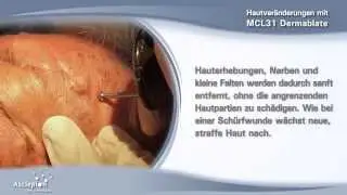 Behandlung von Hautver&auml;nderungen mit dem Erbium-Laser MCL31 Dermablate von Asclepion