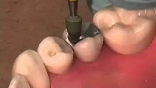 Amalgam Restoration Polishing small