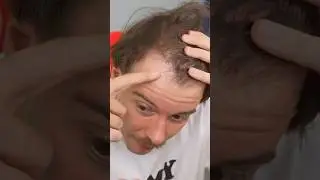 Aditotoro's hair is lost