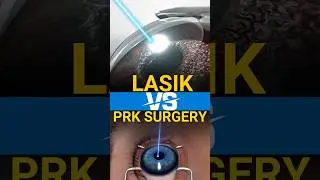 Lasik Vs PRK Surgery for Specs Removal