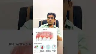 Homeopathy medicine on Gingivitis (Gum swelling) #trending #yt #ytstudio #shorts #short #shortsvideo