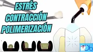 Estrés de contracción por polimerización en las resinas compuestas 🦷