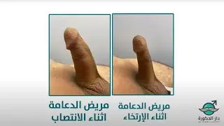 الفرق بين و ضع الارتخاء ووضع الانتصاب بعد تركيب الدعامة