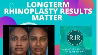 Longterm Rhinoplasty Results!