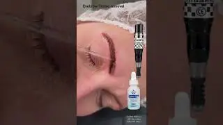Eyebrow tattoo removal with color lift solution