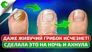Даже ЗАСТАРЕЛЫЙ грибок ИСЧЕЗНЕТ на утро! 30 лет мучилась, а НОГИ СПАС этот дедовский секрет