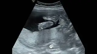 Fetal foot and toes