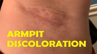 how to get rid of dark underarms naturally at home EASY TRICK