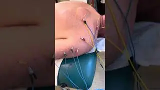 Dry Needling with Electrical Stimulation for Frozen Shoulder in a 54 year old construction worker
