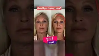 Botox Promotion