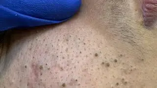 Achieve Flawless Skin: *FACIAL CARE ROUTINE* For Pimple-Free Living