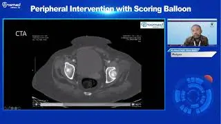 Tri wedge Webinar Part 3  Dr  Ahmad Rafizi Hariz Ramli & Discussion & Summary Lower Limb Interventio