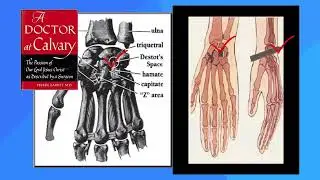 1.6 Wrist wounds on the Shroud of Turin