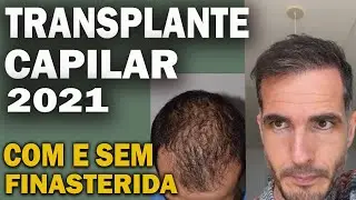 TRANSPLANTE CAPILAR EM 2021 3 ANOS DEPOIS | O CABELO CAIU? TEM QUE USAR FINASTERIDA? VALE A PENA?
