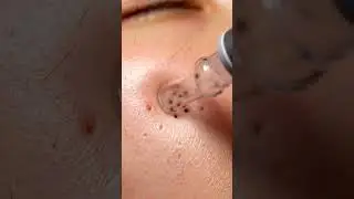 &ldquo;Most Satisfying Blackhead Vacuum Extraction Ever! Real Deep Pore Cleaning ASMR for Stress Relief,