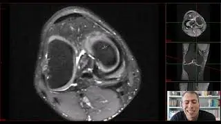 Joelho - Flape Horizontal Meniscal - Depois dessa, n&atilde;o erra mais!