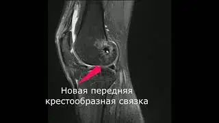 Revision ACL