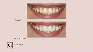 Smileactives Set of 2 Whitening Pens with Bonus Pen Auto-Delivery on QVC
