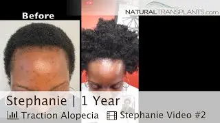 African-American Hair Transplant for Traction Alopecia Hair Loss | Dr. Kevin Blumenthal (Stephanie)