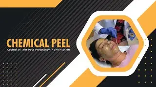 Chemical Peel | Cosmelan | for Post Pregnancy Pigmentation | West Hollywood, CA | Dr. Jason Emer