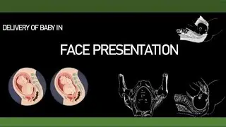 Delivery of Baby in Face Presentation