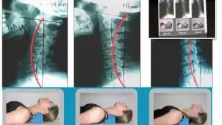 Denneroll CBP Cervical Traction