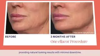 Intro Ellacor® System with Micro-Coring® Technology