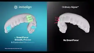 Invisalign | 5 Test Check - SmartForce