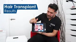 Reviewing past Hair Transplants - Julian