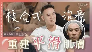 【凹疤治療見證】填平凹疤，找回自信眼神｜佳立診所