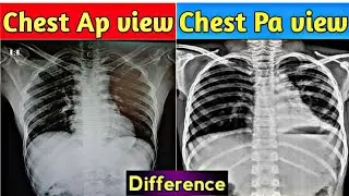 Chest X-Ray Ap view Vs Chest Pa view | How to Differentiate | Uday Xray