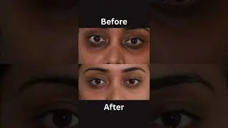 7 days Fair eyes challenge: Dark circle removal🤫🤫
