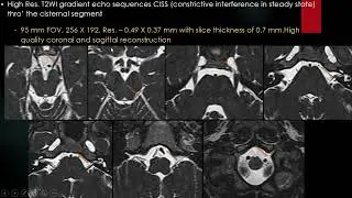 Approach to Cranial Nerve Palsy