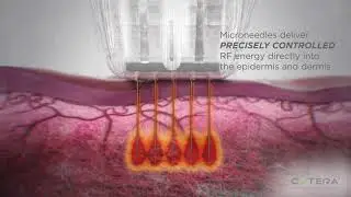 Radio Frequency (RF) Microneedling with Secret RF at Miami Skin Spa.