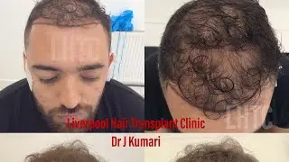 Hair Transplant UK | 12 Months Results | Dr J Kumari | LHTC