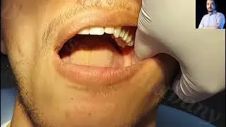 Local Anesthesia, Inferior Alveolar Nerve block Technique, mandibular nerve block Technique #dentist