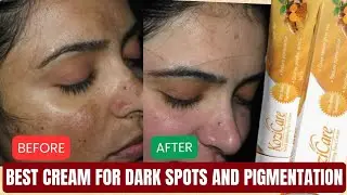 Best cream for dark spots and pigmentation || Kozicare skin lightening cream review 
