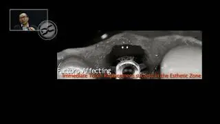 Immediate implant placement - factors influencing the esthetic success