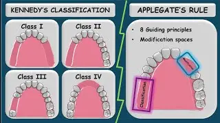 Kennedy's Classification & Applegates Rule | Prosthodontics