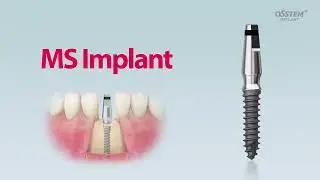 Mini Implant - MS System