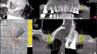 Dynamic Surgical Navigation in Transcrestal Sinus Augmentation, A Novel Approach