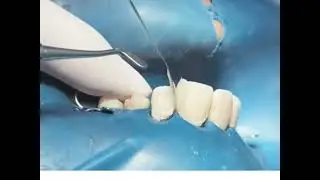 Making the Patient Smile Again.. Big Caries/ cavity in his front teeth..