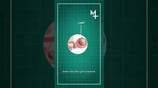 Testicular Cancer Symptoms | How to Prevent Testicular Cancer | MASSH Hospitals