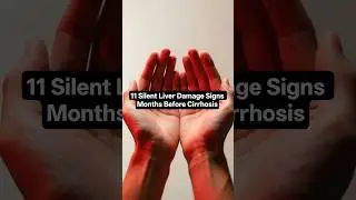 11 Silent Liver Damage Signs Months Before Cirrhosis (Don&rsquo;t Ignore These) #shorts #liverhealth