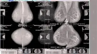 iQ-VIEW PRO MAMMO